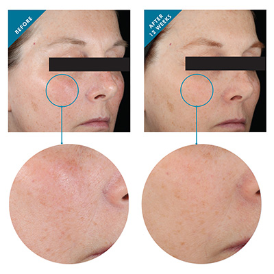 skinceuticals visibile-results before-after-12-weeks 02-27-2015 72dpi