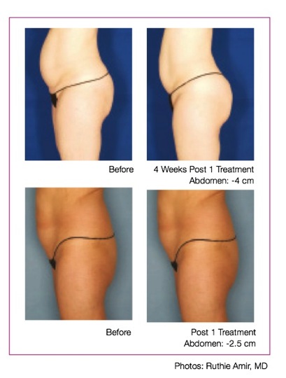 velashape3 before and afters prof bty HP