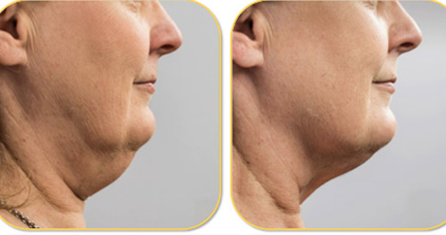 A jaw dropping result from CoolMini 12 weeks after treatment
