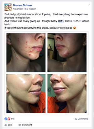 The change is a result of: "2 DMK Enzyme treatments and aftercare products working their magic."