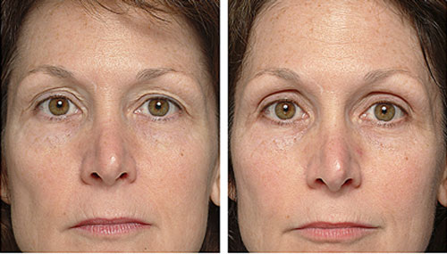 thermage-before-and-after
