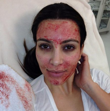 Kim Kardashian PRP treatment