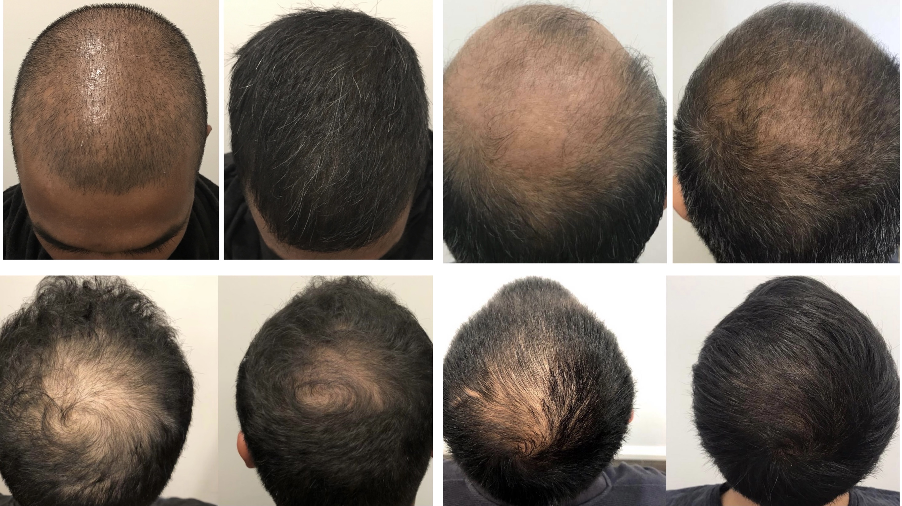 Hair Loss Because of Stress  Blue Water Spa  PRF Injections Raleigh
