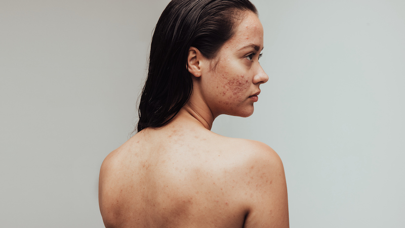 The Science Behind Acne And Suitable Skincare Solutions