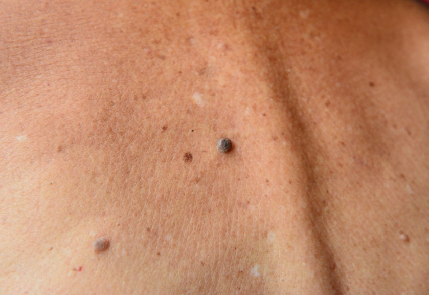 How This Peptide Breakthrough Shows Promise Against Drug-Resistant Melanoma